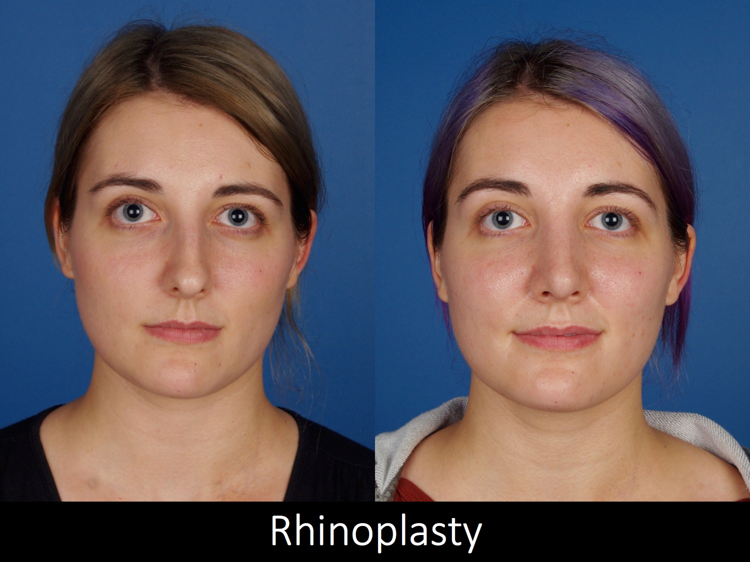 Denver Rhinoplasty Before And Afters Raval Facial Aesthetics